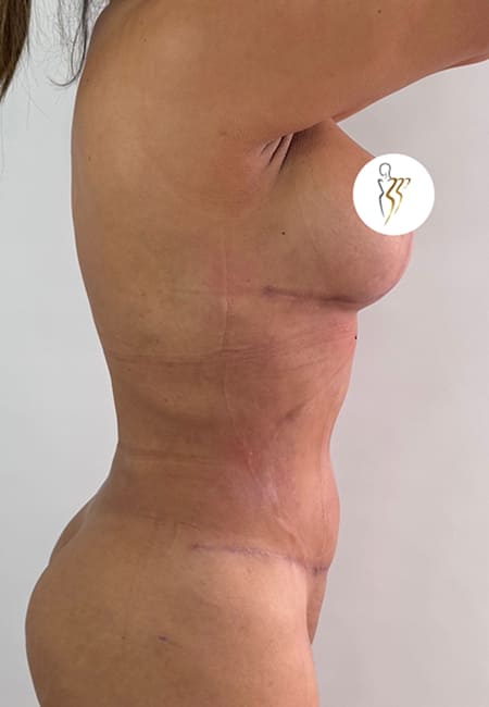 Lipolisis 1