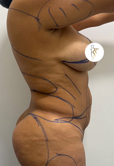 Lipolisis 2