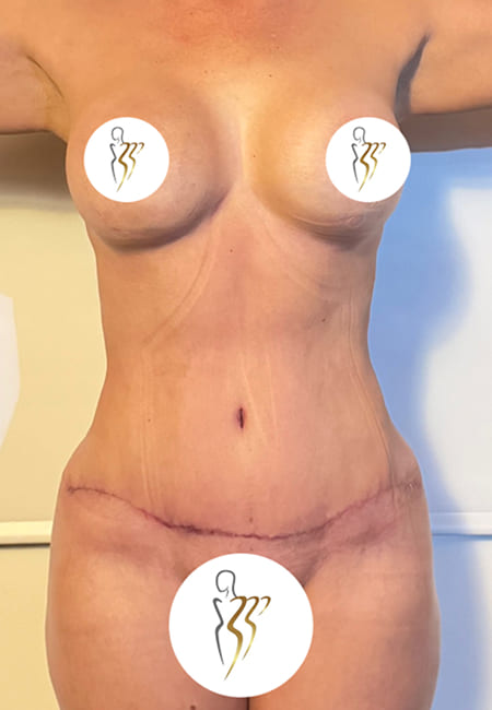 Lipolisis 4