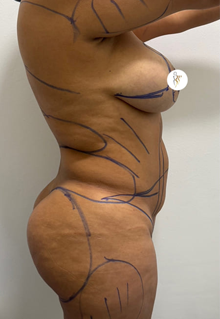 Lipolisis 5