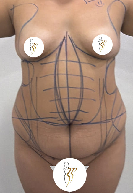 Liposuccion 1