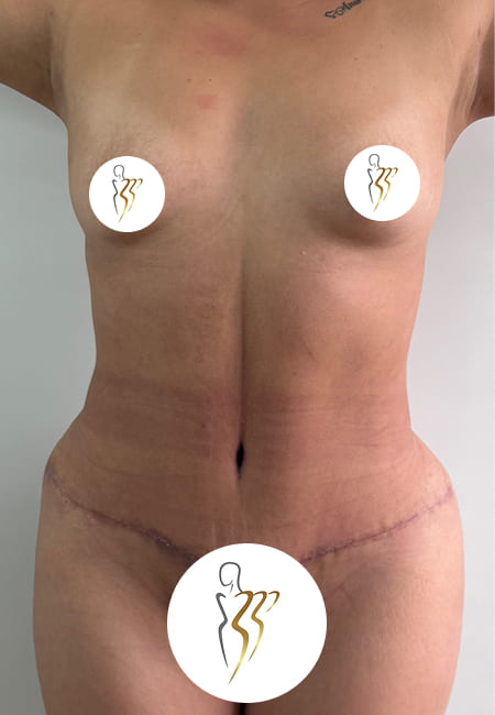 Liposuccion 2