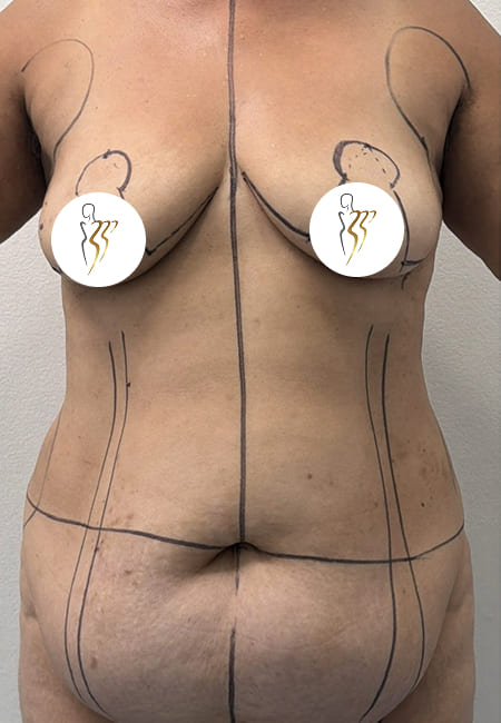 Liposuccion 3