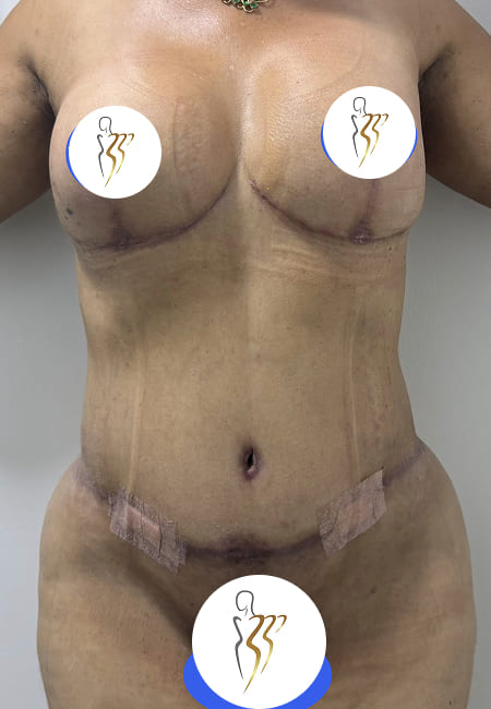 Liposuccion 4