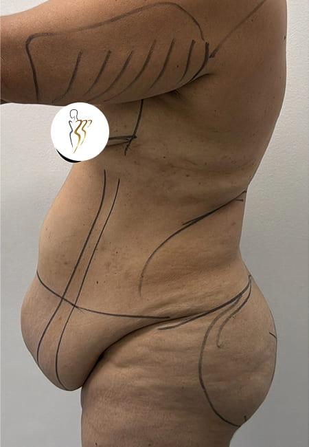 Liposuccion 5